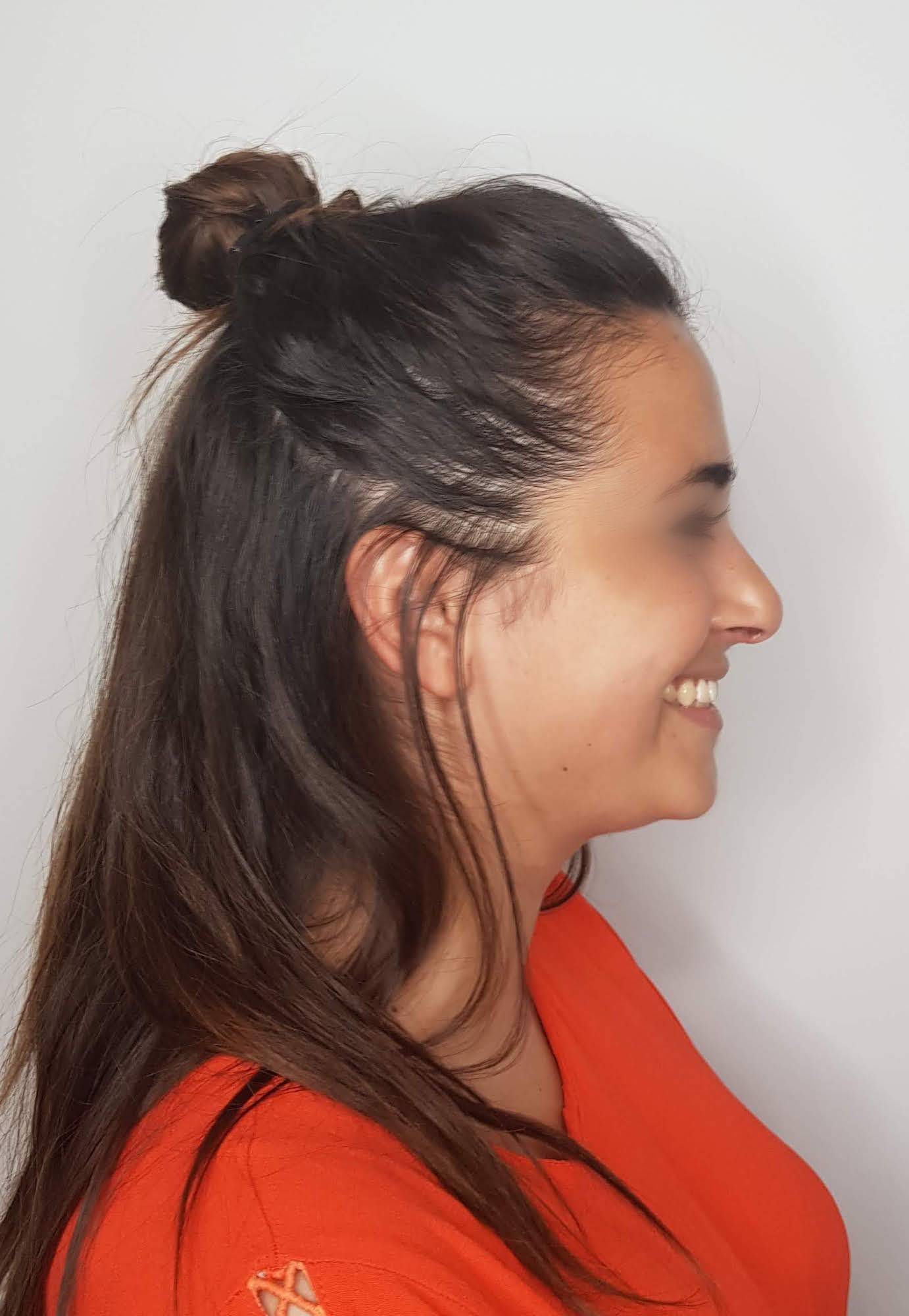 pointe tombante avant apres chirurgie