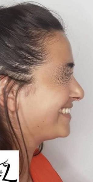 Rhinoplastie ouverte ultrasonique