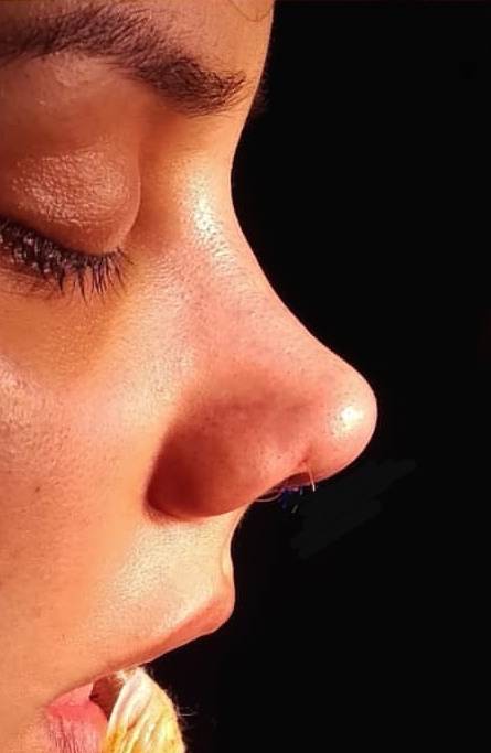 bec de corbin rhinoplastie secondaire dr lari