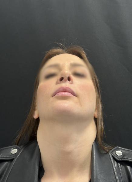 cicatrice apres rhinoplastie ultrasonique à 3 semaines 